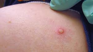 Eleven cases of monkeypox confirmed in nsw