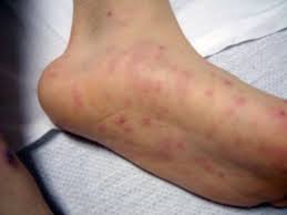 PUBLIC HEALTH ALERT: MENINGOCOCCAL DISEASE