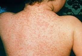 MEASLES CASE IDENTIFIED IN NSW